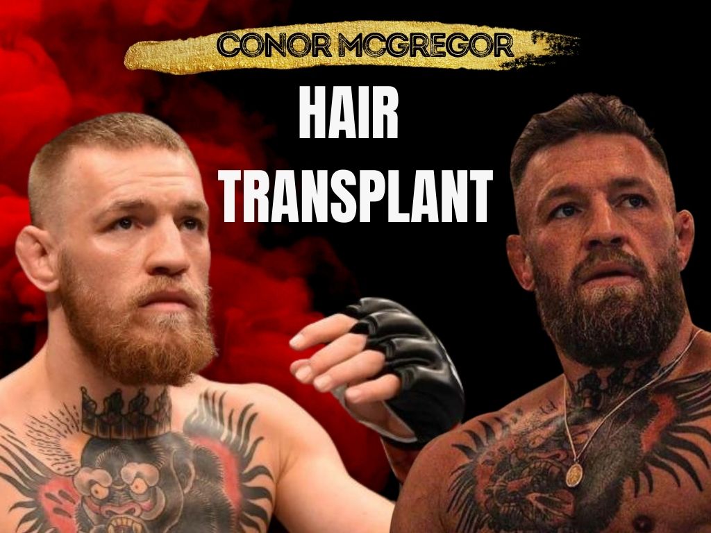 Is Conor McGregor Balding? Hair Loss Journey Explained
