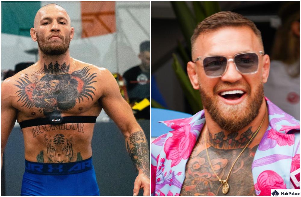 McGregors Bald Spot: Is the UFC Star Facing Hair Loss?