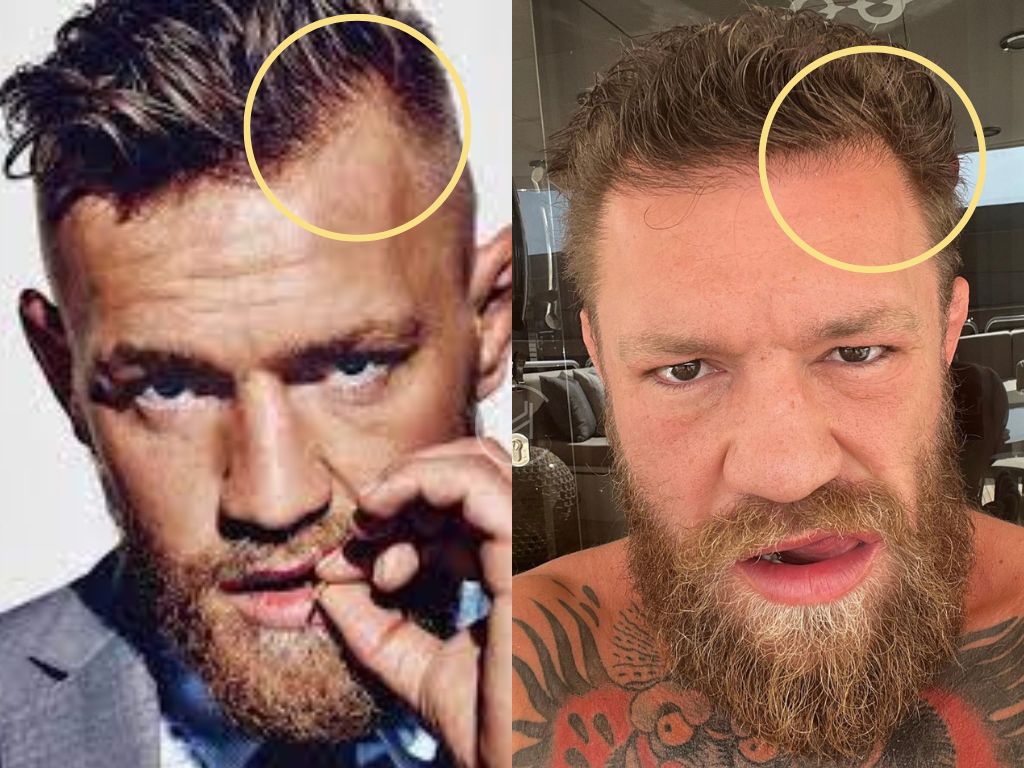 Is Conor McGregor Balding? Hair Loss Journey Explained