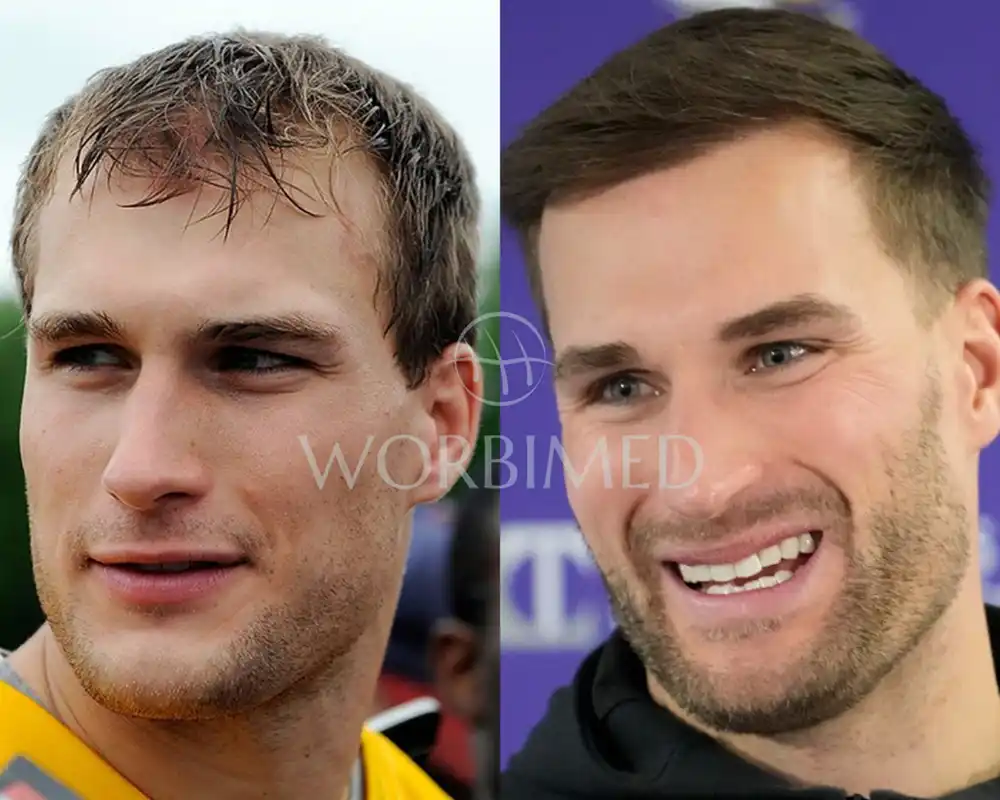 Kirk Cousins Hair Transformation: From Thinning to Thick