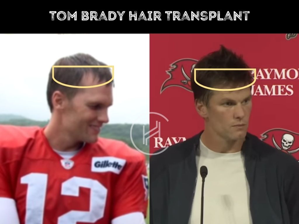 Did Tom Brady Have a Hair Transplant? Exploring His Hairline Transformation