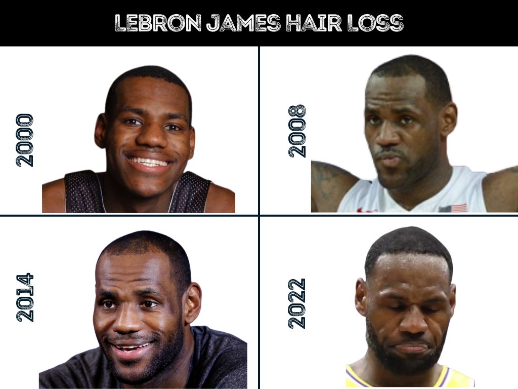 Did LeBron James Have a Hair Transplant? A Look at His Hair Before the Procedure