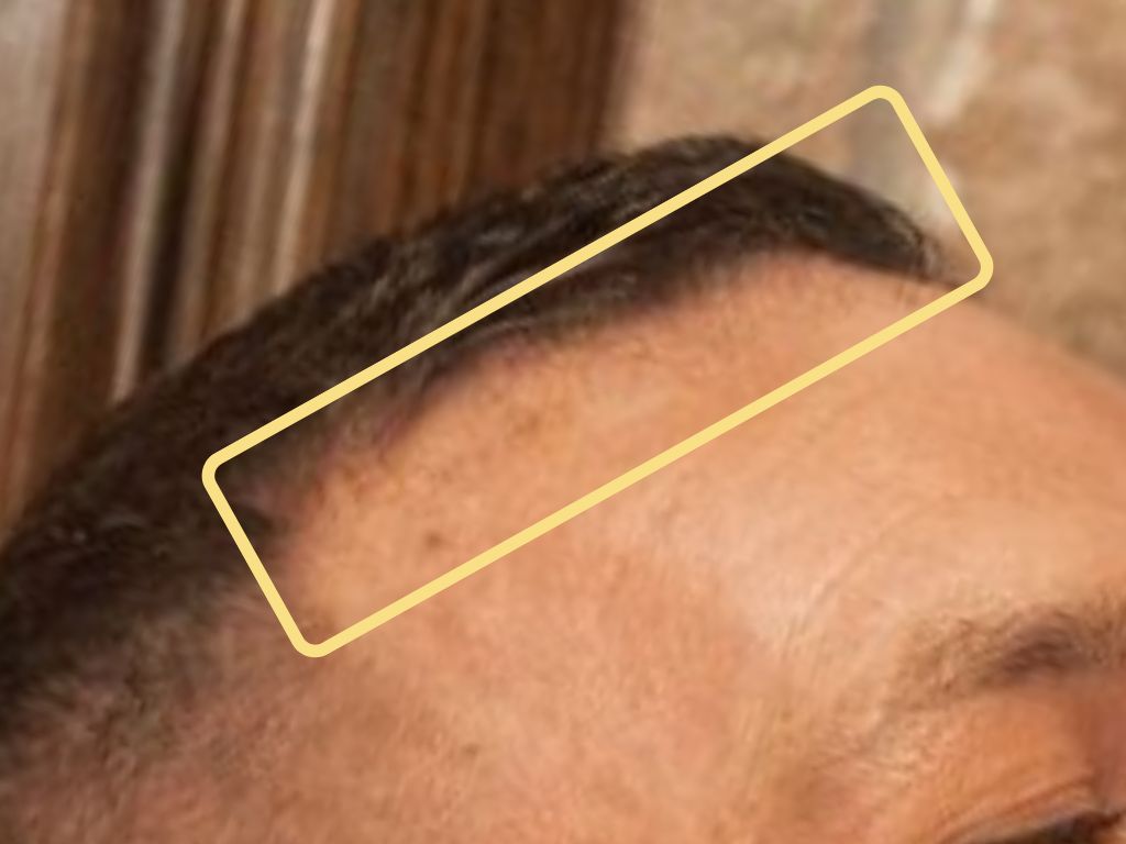 Conor McGregor Bald Spot Revealed: The Truth Behind His Hair Loss