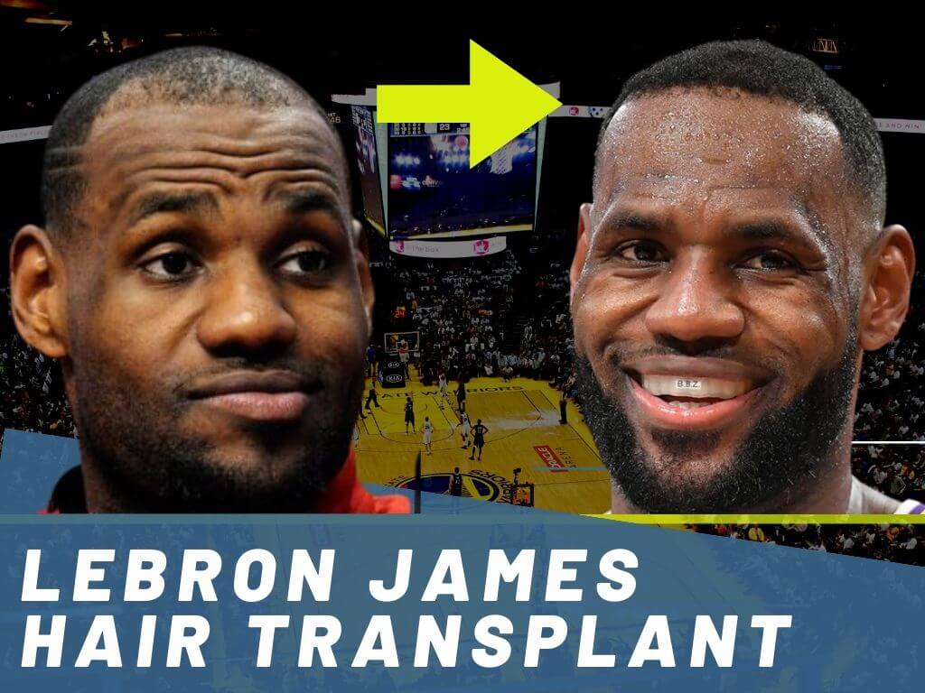 Did LeBron James Have a Hair Transplant? A Look at His Hair Before the Procedure