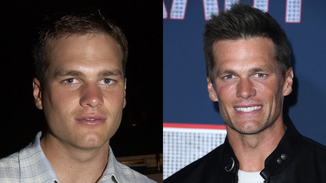 Did Tom Brady Have a Hair Transplant? Exploring His Hairline Transformation