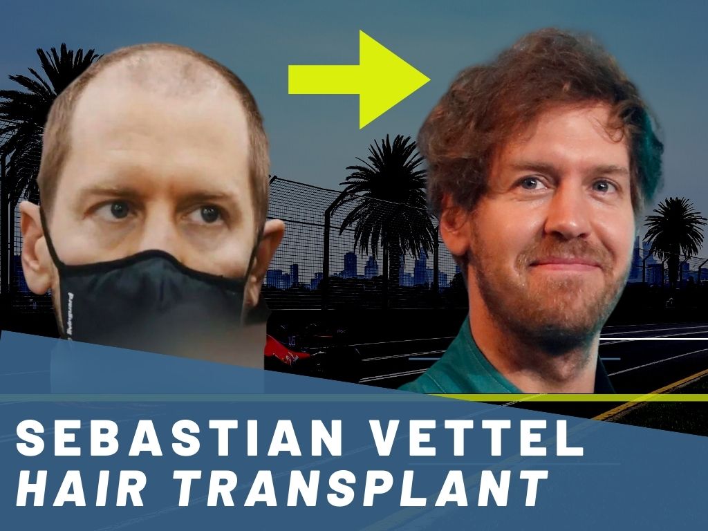 Sebastian Vettels Hair Journey: From Thick Curls to His Aston Martin Look