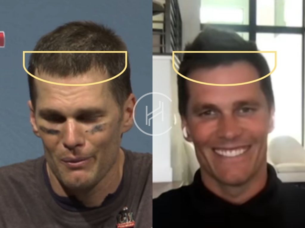 Did Tom Brady Have a Hair Transplant? Exploring His Hairline Transformation