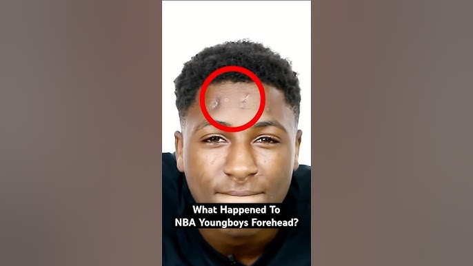 Whats up with NBA YoungBoys head? Here is what happened to NBA youngboys head lately