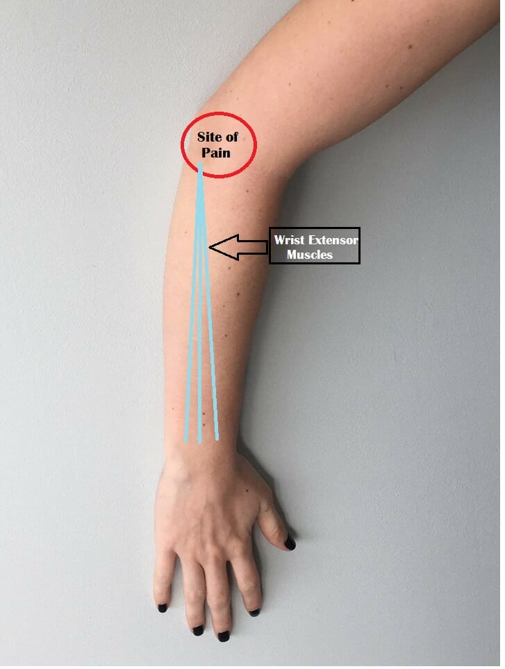 How Effective is Acupuncture in Treating Tennis Elbow?