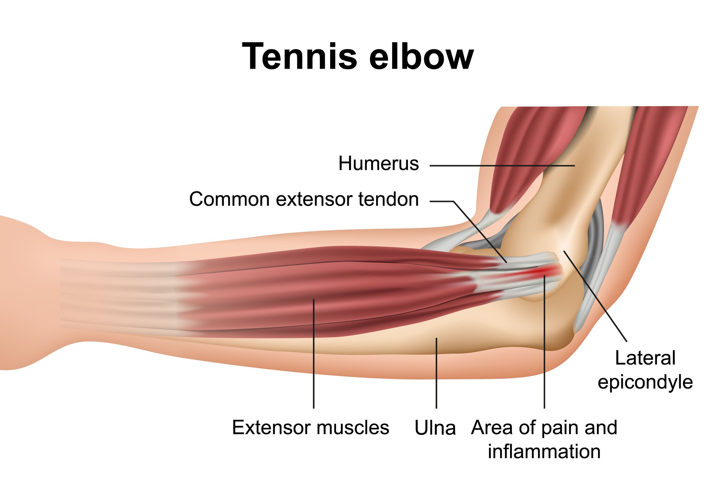 How Effective is Acupuncture in Treating Tennis Elbow?