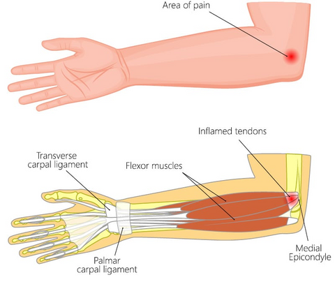 Tennis Elbow Pain When Lifting Weights? How to Modify Your Routine