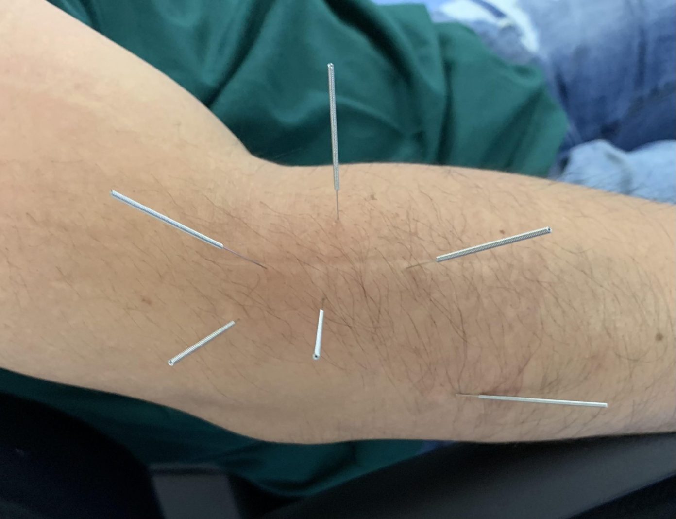How Effective is Acupuncture in Treating Tennis Elbow?