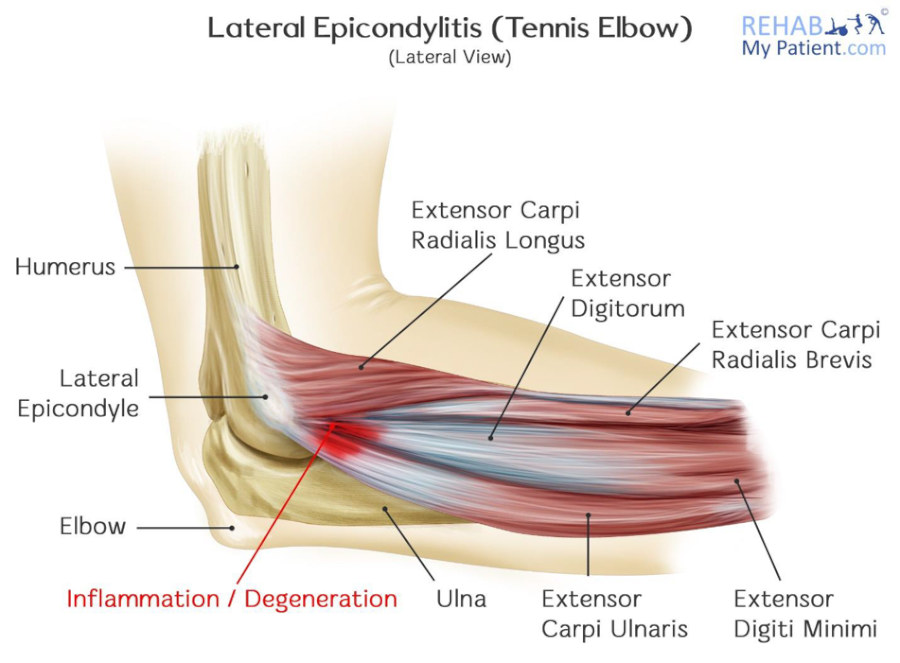 Does Compression Help Tennis Elbow Symptoms? Expert Advice!